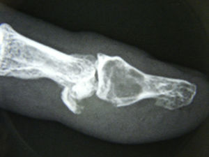 Radiological image of lytic lesion with avulsion of the flexor.