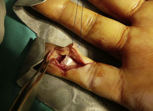Image of the intra-operative findings.