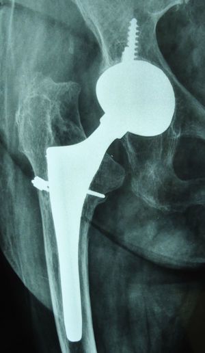 Sinking of Meridian stem 9 months post-operatively following type B2 intra-operative femur fracture treated with wire cerclage.