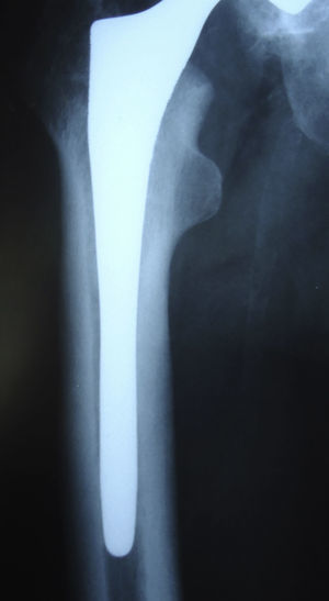 Meridian stem with radiological osseointegration after 9 years of follow-up.