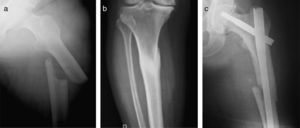 Case report number 3. Atypical diaphyseal proximal fracture of the femur: (a) post-fracture X-ray, (b) consolidated stress fracture of the tibia, and (c) X-ray following endomedullary nailing.