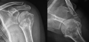 (A) Anteroposterior X-ray of the left shoulder in the scapular plane raising suspicions of absence of consolidation following fracture of the proximal humerus in 3 parts. (B) True axillary X-ray of the left shoulder showing pseudoarthrosis at the level of the metaphysis and partial consolidation of the trochiter.