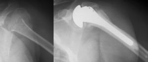 (A) Anteroposterior X-ray of the left shoulder. Sequela of 3-part fracture of the proximal humerus that evolved into pseudoarthrosis. (B) A hemi-arthroplasty was put in place with osteotomy of the trochiter and evolved into pseudoarthrosis with a modest functional outcome.
