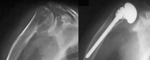 (A) Anteroposterior X-ray of the right shoulder in the scapular projection. Malunion of the proximal humerus with the cepahlic fragment consolidated in varus position. (B) Treatment with a total shoulder arthroplasty. A slight placement of the humeral stem into varus position was carried out, in order to avoid performing a lesser tuberosity osteotomy.