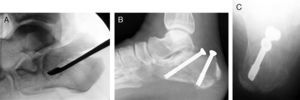 Tongue-type fracture treated with closed reduction and percutaneous fixation. (A) Percutaneous reduction through a very small lateral incision for using a wedge to raise the tongue-type fragment. (B) Follow-up lateral x-ray showing the reduction achieved and fixation with 2 6.5-mm cannulated screws in anterolateral and posteromedial orientation. (C) Axial view of the same case.