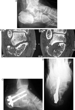 Reconstruction and minimally invasive primary arthrodesis. (A) Lateral x-ray of Sanders grade IV fracture. (B) CAT image showing comminution of the joint. (C) Control x-ray following reconstruction and fixation of the talus using the Vira system. (D) Axial image of the same case.