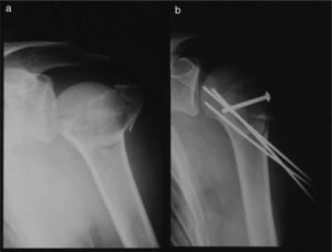 (a) Initial fracture; (b) post-operative result.