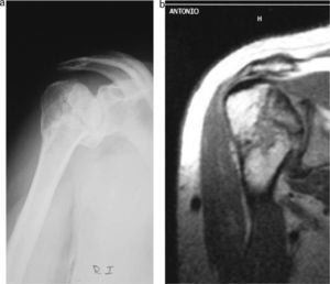 (a) Radiological image of avascular necrosis; (b) MRI image.