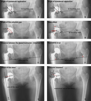 Representation of the radiographic measurements analysed with the Trabeculae® SACRA-ATC® application. (A) The angle of acetabular inclination is formed by the line that crosses the CUPs and the CUPi with the perpendicular of the bi-teardrop line. (B) The angle of acetabular abduction is calculated as that complementary to the angle of acetabular inclination. (C) The angle of the cotyloid cup model in the AP plane is determined using the Visser-Connings method. (D) The Voss effect is given by the distance between the GT and the CFH. If both are parallel, the Voss effect is neutral; if the GT is below the CFH, it is negative; and if it is above the CFH, it is positive. (E) The distance between the LT of the affected femur and the biischial line. (F) Dysmetria is calculated as the difference between the biischial GT line of the affected side and that of the contralateral joint. (G) The offset of the stem is the distance between the CFH to the longitudinal axis of the artificial joint stem. (H) The abductor moment is calculated by tracing a line from the GT that forms a 35° angle with the anatomical axis of the femur, and measuring the distance between this and the CFH. CUPi, lowest internal point of the dome plane; CUPS, highest external point of the dome plane; CFH, centre of the femoral head; GT, greater trochanter; LT, lesser trochanter; ST, stem tip; TDC, teardrop on the contralateral joint; TDS, teardrop of the affected side.