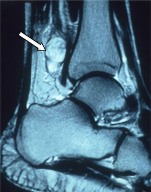 Magnetic resonance image showing a mass (white arrow) in the distal third of the right lower extremity.