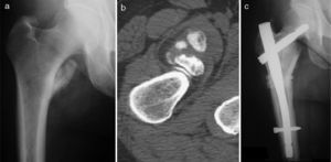 Case 4: appearance on X-ray (a) and on an axial CT slice (b) prior to surgery; control X-ray 3 years after surgical treatment (c).