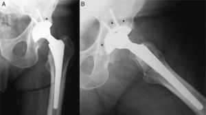 On anteroposterior (A) and axial (B) views of the hip, a slight cranial displacement of the head is appreciated with respect to the metallic tray of the acetabular component (*), as well as signs of periacetabular osteolysis.
