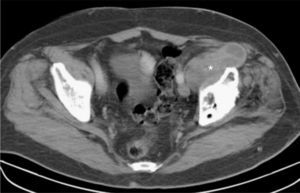 CT scan of the pelvis showing a lobulated cystic swelling (*) of about 7cm in diameter in the left iliac fossa.