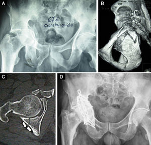 (A and B) Transtectal transverse and posterior wall fractures in a 67-year-old male. (C) Post-operative control computerized axial tomography showing inadequate reduction and fixation of the anterior column. (D) Osteoarthritis of the hip, Tönnis III, at 37 months after surgery.