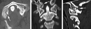 Cervical computerized axial tomography for patient 1: impacted fracture of right occipital condyle and C1 fracture.