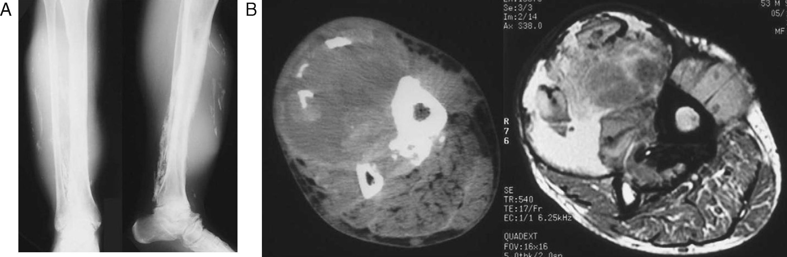 Tibia Calcification Calcific myonecrosis of the leg | Revista Española de Cirugía ...