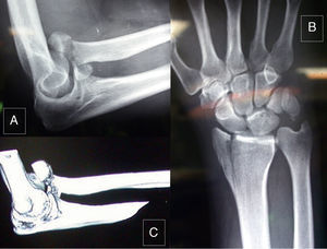 Right elbow: (A) X-ray of elbow profile; (B) AP X-ray of the wrist; (C) computed tomography (CT) scan.