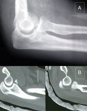 Left elbow: (A) AP X-ray; (B) computed tomography (CT) scan.