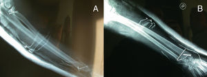 Post-intervention radiological image of the upper right limb. (A) AP X-ray; (B) lateral X-ray.
