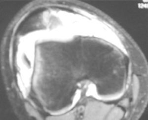 Magnetic resonance image of the knee, transversal cut. Osteochondral fracture of the medial patellar facet with 2 free fragments, focal osseous contusion; impacted fracture from impaction on the border of the external femoral condyle and a lesion in the internal and patellofemoral ligaments.