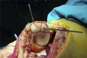 Image of the medial osteochondral patellar injury in the right knee during surgery, showing reconstruction with resorbable screws.