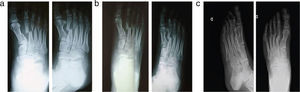 Fracture of metatarsals I, II, III and IV of the right foot treated with the functional method. (a) Simple radiological study at 7 days of evolution; (b) simple radiological study 2 months after the accident; (c) simple radiological study 13 months after the accident.