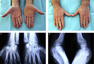 Clinical aspect of the hand (a and b). Radiological study of the right wrist (c and d).