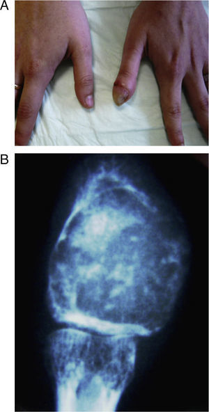 (A) Clinical aspect of the thumb. (B) Radiological image of the tumorous lesion.