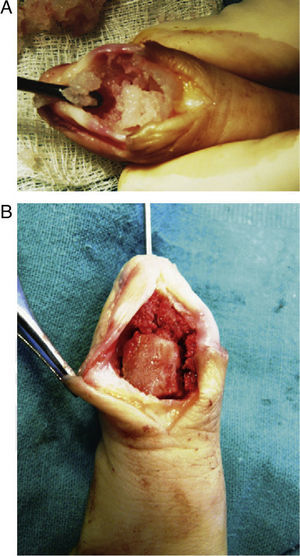 Surgical reconstructive technique. (A) Tumour cavity curettage. (B) Cavity filling with cancellous chips and a structural cortico-cancellous graft. Stabilisation with an axial Kirschner wire.