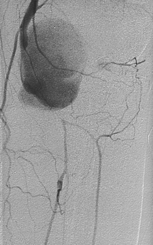 Arteriography. Pseudoaneurysm and distal bypass through genicular branches to anterior and posterior tibial arteries.