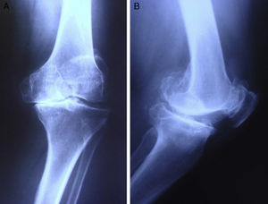 Initial radiographic examination. (A) Anterior–posterior projection. (B) Lateral projection.