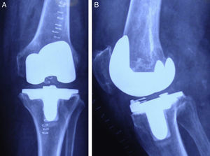 Immediate postoperative radiographic control. (A) Anterior–posterior projection. (B) Lateral projection.