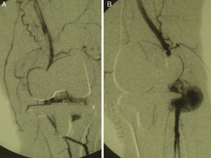 Lower limb arteriograph, showing the popliteal artery pseudoaneurysm. (A) Anterior–posterior projection. (B) Oblique projection.