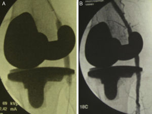 Placement of the stent in the popliteal artery (A) and arteriographic verification of its permeability (B).