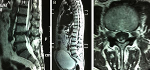 Sagittal (A and B) and axial (C) T2 images that show the sequestered disc fragment at the posterior epidural level of L3–L4. (B) Significantly distended bladder.