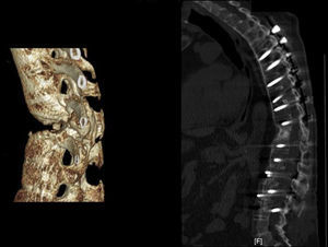 Applying the brace principle with an increase in neutralisation. (a) 3D CT Image of a diabetic patient with ankylosing spondylitis in haemodialysis treatment. (b) Anterior approach with intersomatic tricortical autograft on the iliac crest via an anterior pathway combined with posterior instrumentation. Unlike the previous case, the number of posteriorly fixated vertebrae has been extended due to the characteristic spinal osteoporosis of this illness. The biomechanical construct is stable because it compresses anteriorly, but it will be subject to posterior failure if few levels are fixed due to poor pedicle bolt anchorage.