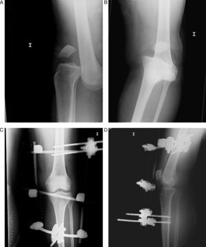 Image from a 23-year-old male, suffering anterior dislocation of his left knee after a traffic accident. Upon arrival he presented weak pulse and ABI<0.9. We performed urgent femoropopliteal bypass with fasciotomy and immobilisation with an external fixator. Simple radiology: anterior dislocation in anteroposterior (A) and lateral (B) projections, anteroposterior (C) and lateral (D) reduction and external fixation.