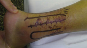 The skin incision was made between the lateral edge of the Achilles tendon and the fibula.