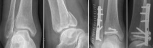 The posterolateral approach enabled use of a single incision to approach the fractures of both the fibula and the posterior articular fragment of the tibia, allowing a direct and anatomical reduction of the joint surface.