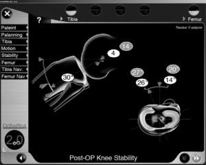Examination of the stability at 30° knee flexion. Preoperative values are shown in grey and postoperative values are shown in white.