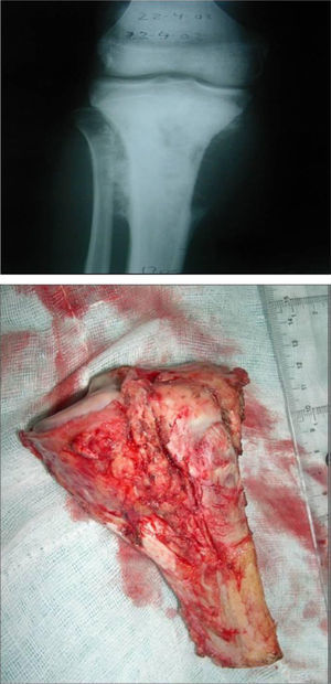 Parosteal osteosarcoma of the proximal tibia. Excision of the tumour.