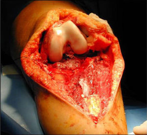 Bone defect created after tumour resection.