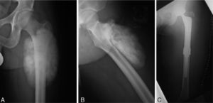 (A) and (B) Superficial osteosarcoma, and (C) reconstruction with megaprostheses.