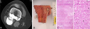 (A) Wide hemicortical intercalary resection, (B) in the osteotomy area, the margin was positive and microscopic foci of high-grade malignancy were found synchronously and (C) pathological anatomy of focus.