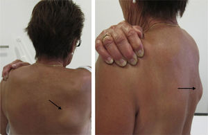 Physical examination in arm flexion and abduction.