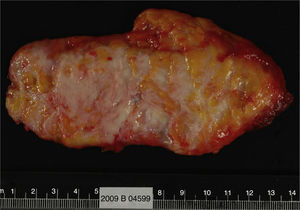Macro: poorly defined tumour with a light grey colour and fibrous tissue interspersed with yellow fat.