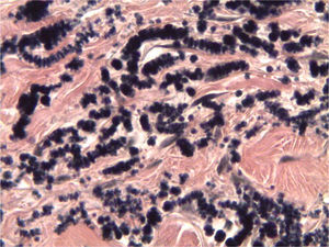 Elastin micro staining: abnormal elastic fibres arranged like beads or globules with serrated edges (×400).