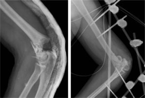 Left: initial radiograph of the supracondylar elbow fracture. Right: postoperative radiograph of the elbow stabilisation by an external fixator.
