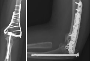 Left: anteroposterior radiograph. Right: lateral radiograph at 2 years evolution.