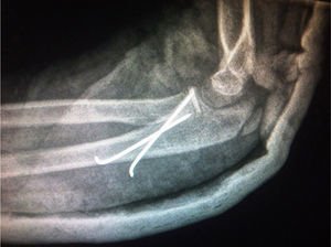 Open reduction and fixation with 2 pins: lateral view.